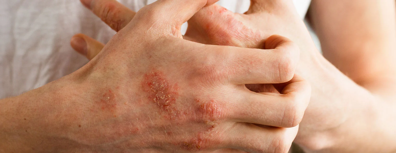 Drugs that Cause Skin Picking and Sores