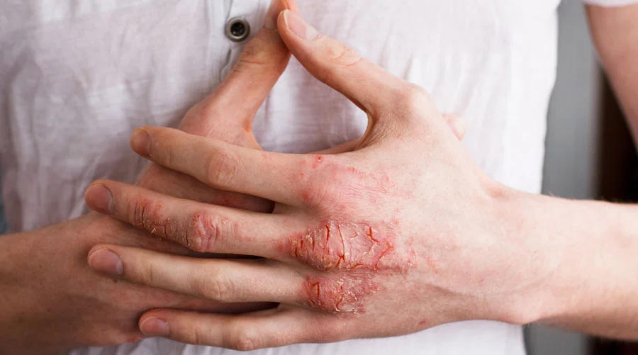 Skin-Picking Psychosis