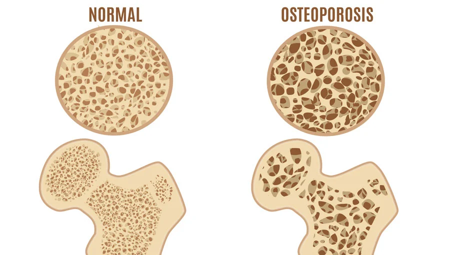 Low Bone Density