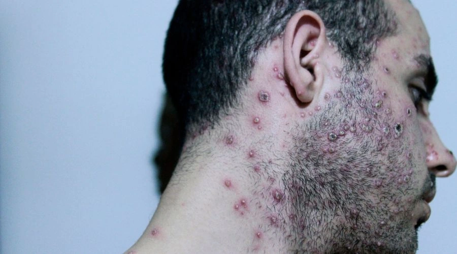 How Meth Use Can Harm Your Skin