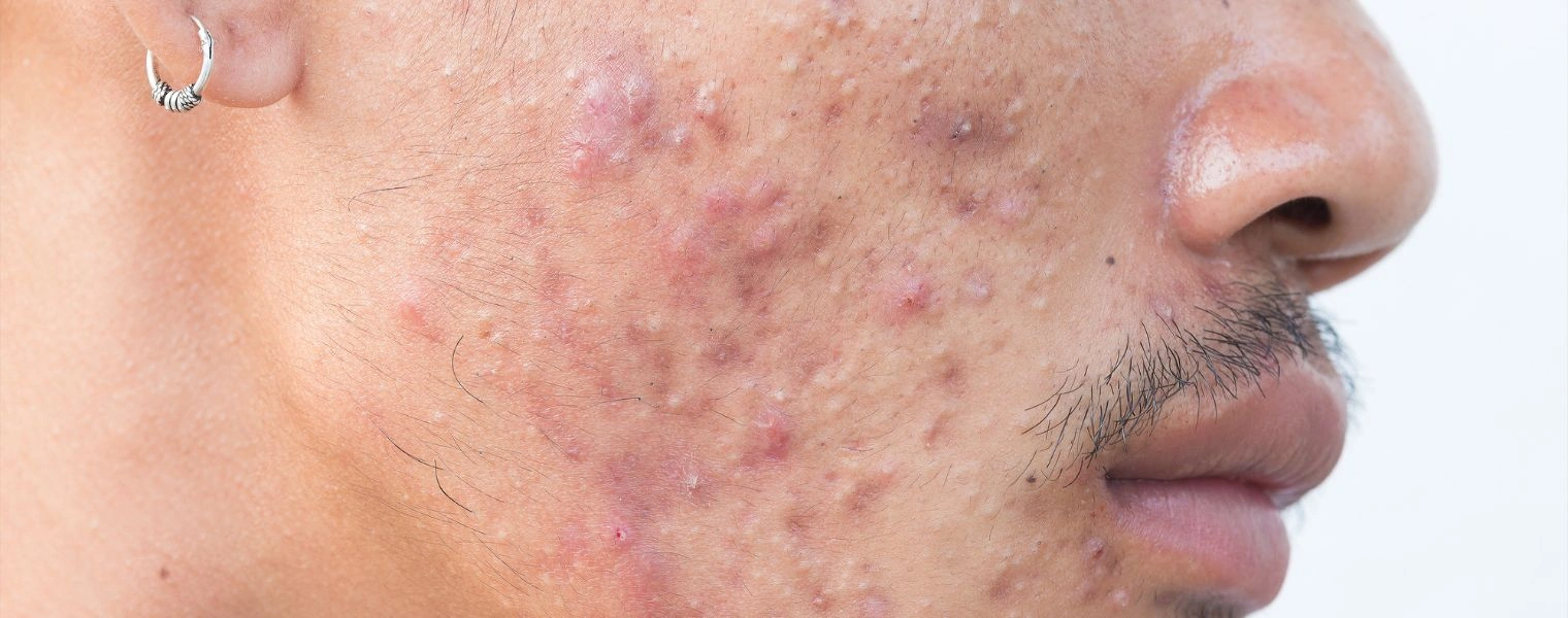 Why Does Meth Cause Acne - Icarus Behavioral Health