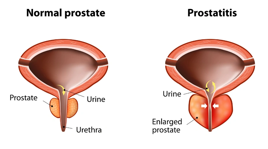 Image of normal and enlarged prostate. Normal Prostate vs Enlarged Prostate
